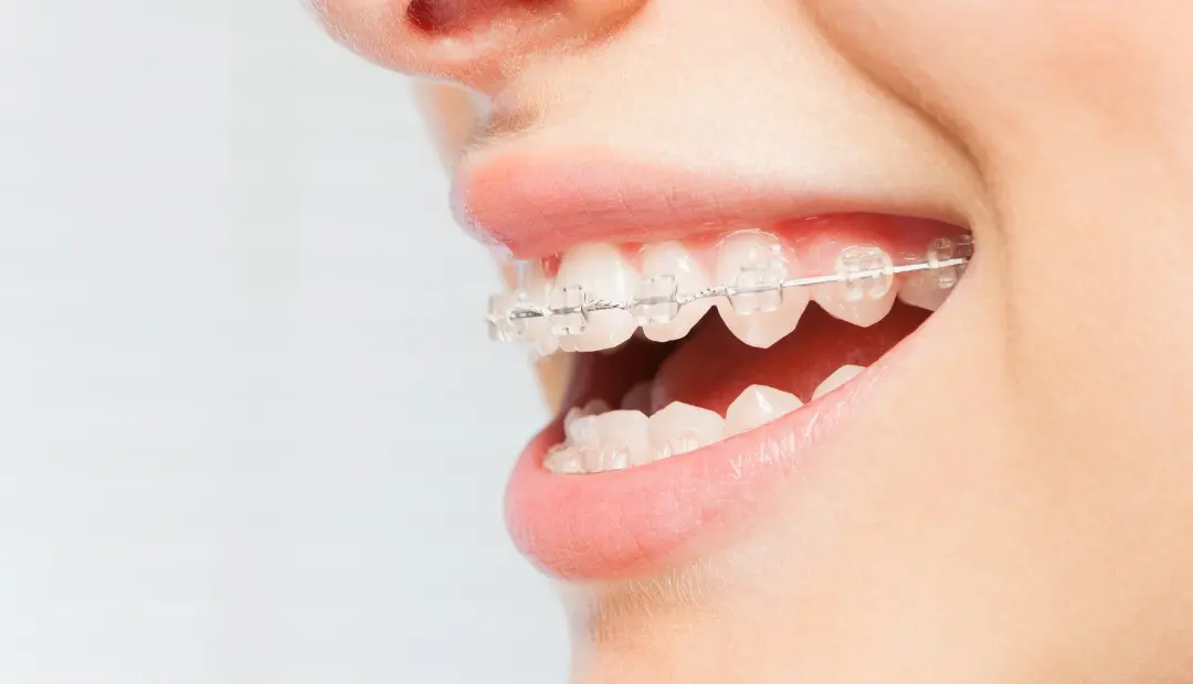 How Much Do Braces Cost in Spring Hill 