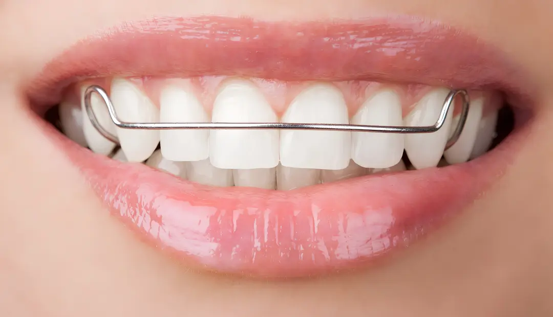 Life After Braces Retainers 101 