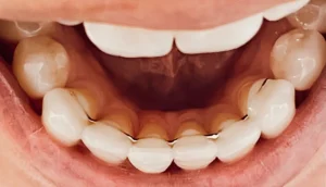 Life After Braces: Retainers 101