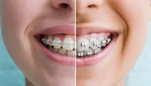 Metal Braces vs Ceramic Braces: Pros and Cons